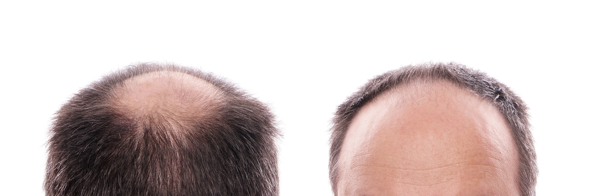 man with circular hair loss at the back of the head and receding hairline at the front