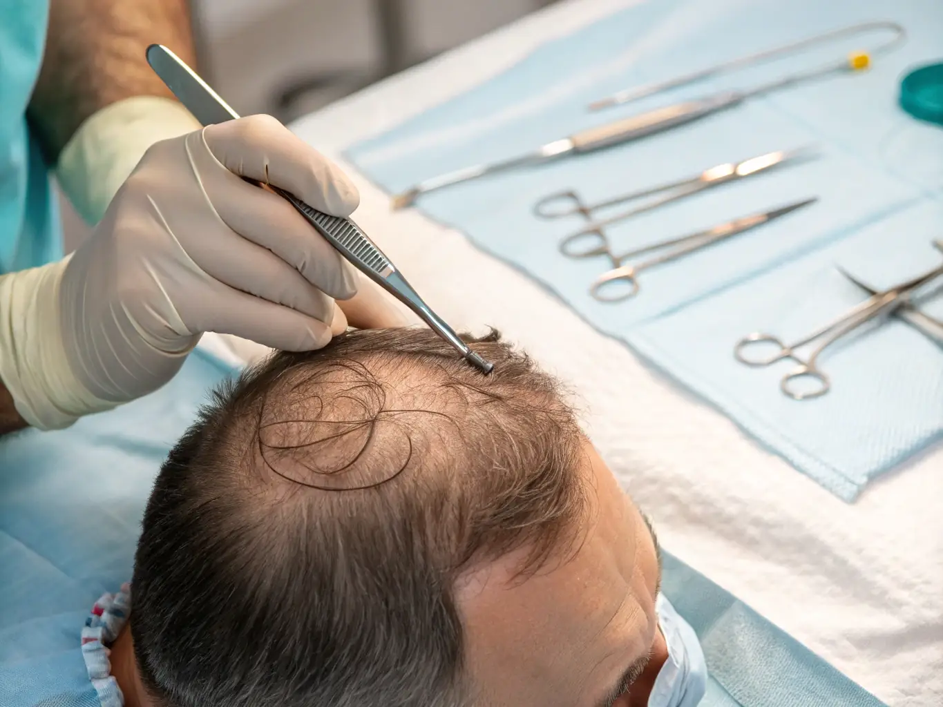 An image illustrating the Sapphire FUE technique, emphasizing the use of sapphire blades for creating micro-incisions in the scalp.